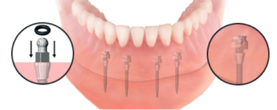 Dental treatment in Tijuana and best suggestion for dental treatment